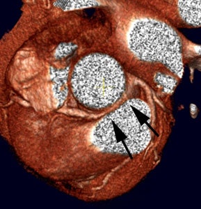 Cardiac > Adultdz > CACalc | AuntMinnie Cardiac > Adultdz > CACalc | AuntMinnie